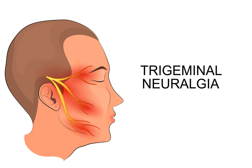 La névralgie faciale ou névralgie du Trijumeau - Le blog du DR. Trotta